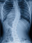 Scoliosis