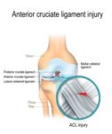 Acl Injury Port