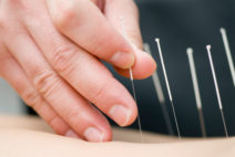 Acupuncture Tcm