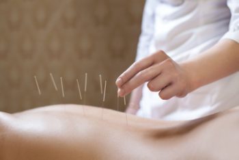 Acupuncture Is Not Just For Pain